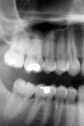 Digital Dental X-ray