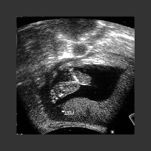 Restoration of the sonogram. This restoration could be further improved if the data was processed before printing the hard copy of the image.