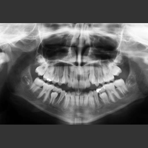 This is a digital dental panoramic X-ray of human teeth. The original image had a bit depth of 8 bits, and had jpeg compression. 