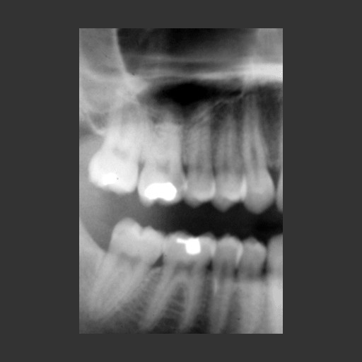 This is another digital X-ray of teeth, pretty typical of all digital X-rays found on many websites.  